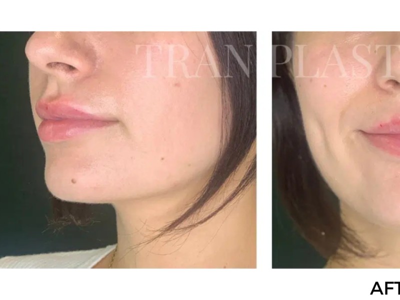 Procedure before and after - before