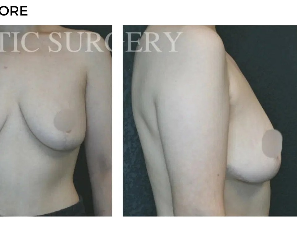 Procedure before and after - after