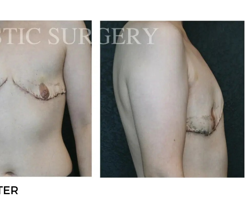 Procedure before and after - after