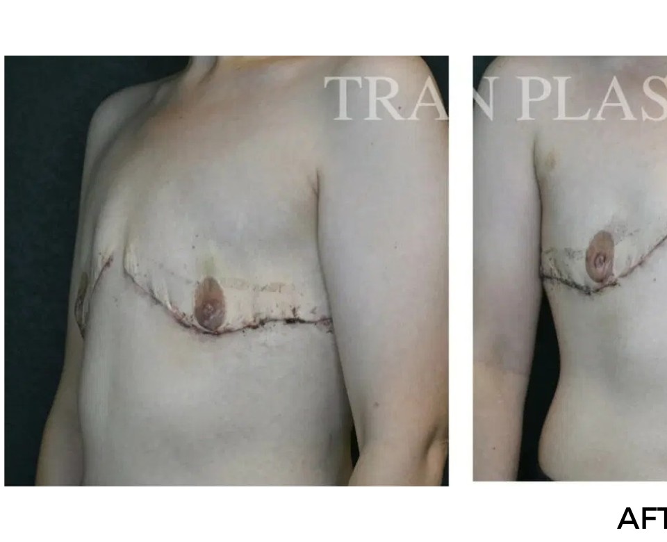 Procedure before and after - before