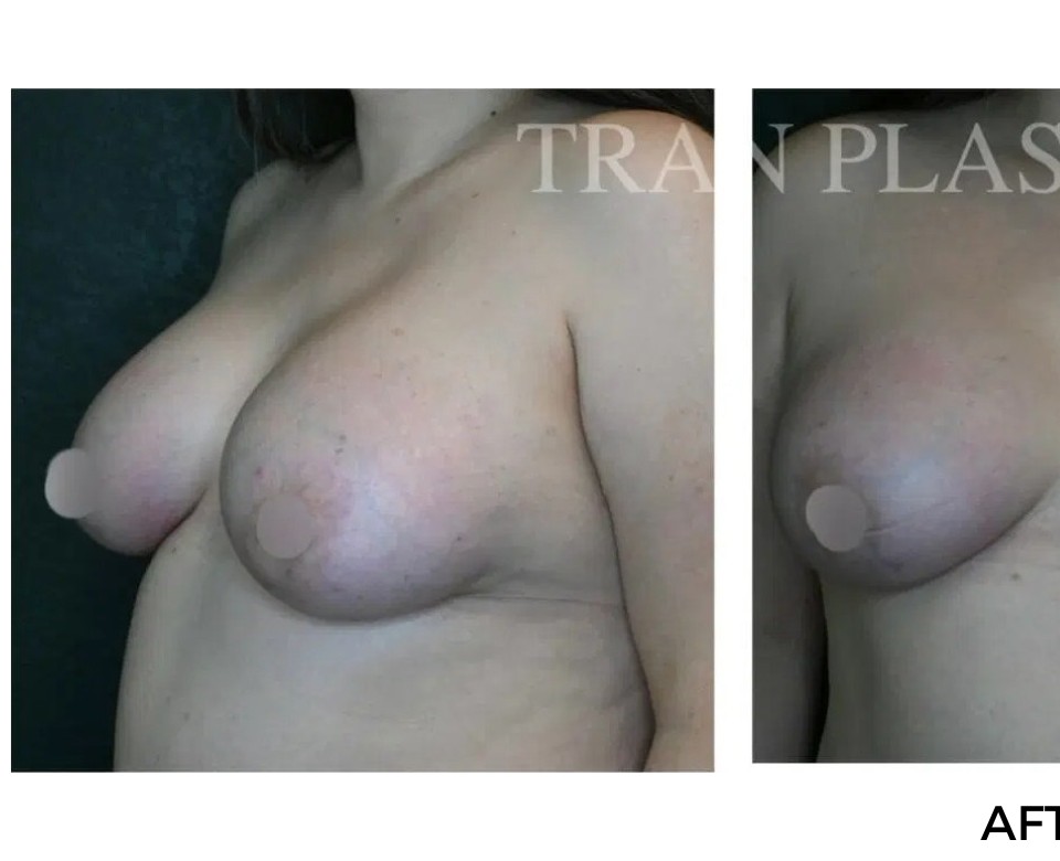 Procedure before and after - before