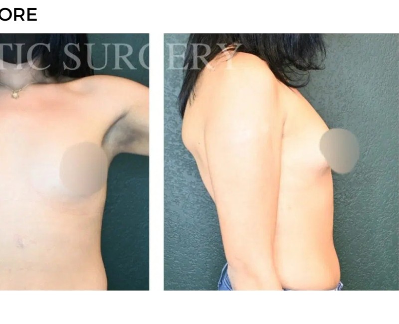 Procedure before and after - after