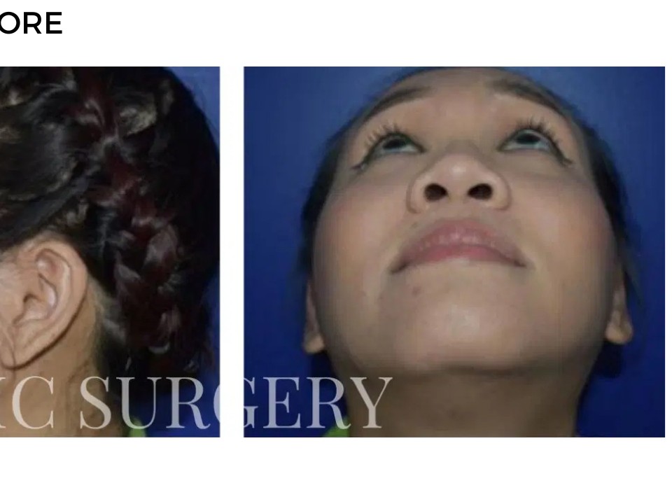 Procedure before and after - after