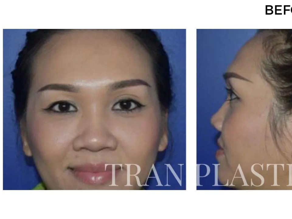 Procedure before and after - before