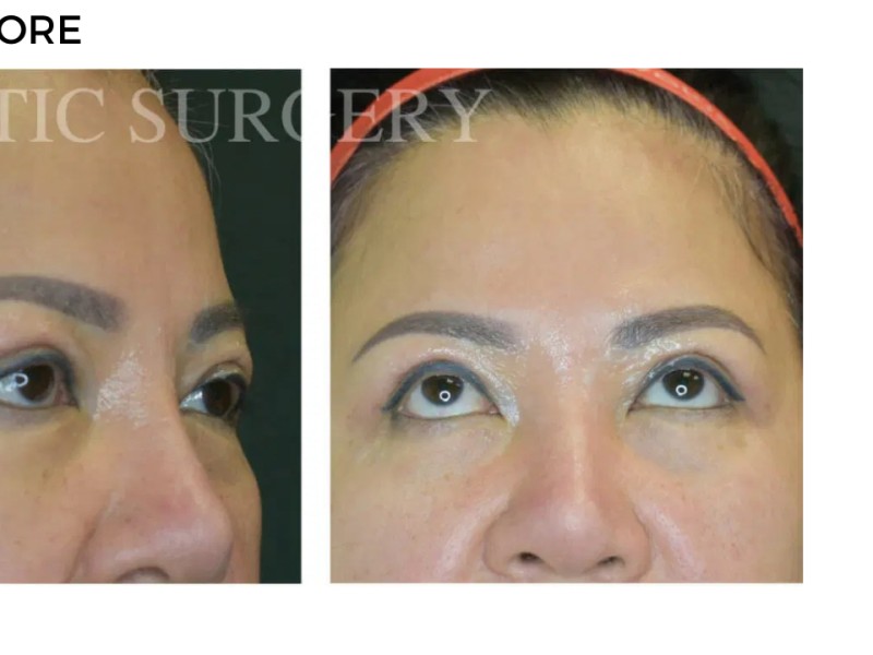 Procedure before and after - after