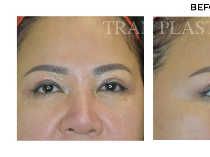 Procedure before and after - before