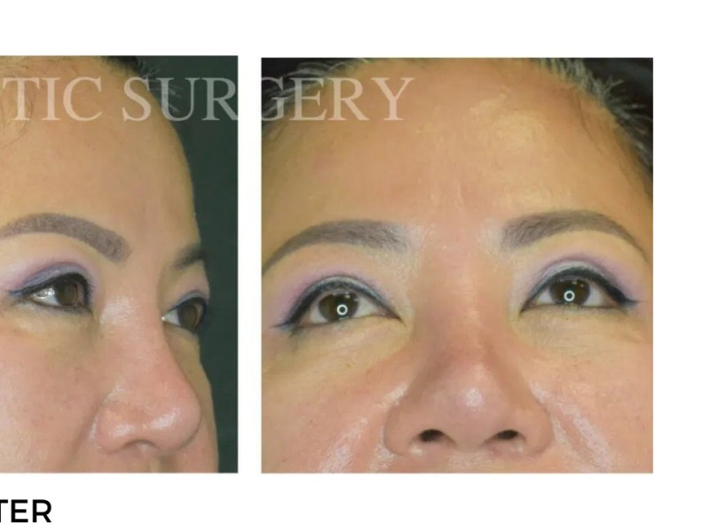 Procedure before and after - after