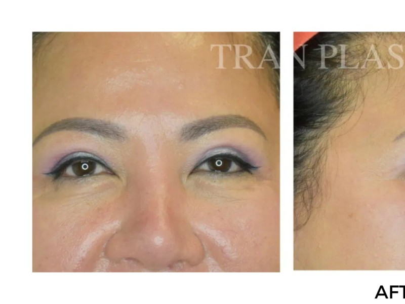 Procedure before and after - before