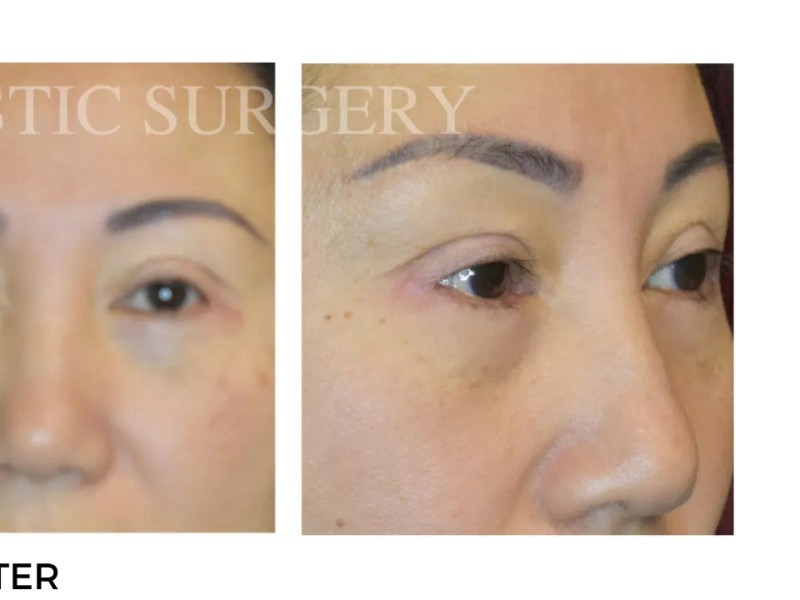 Procedure before and after - after