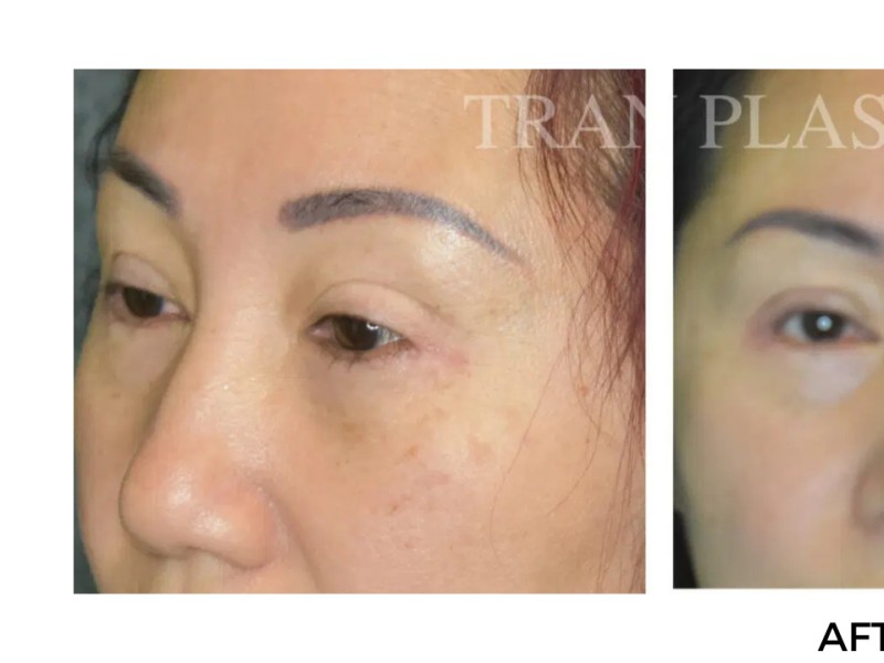 Procedure before and after - before