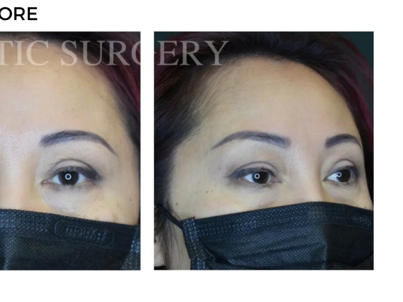 Procedure before and after - after