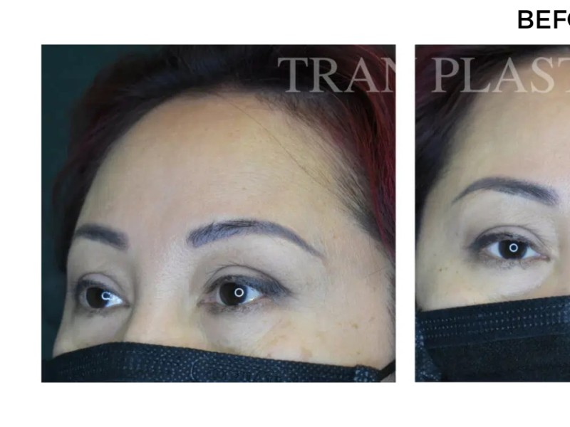 Procedure before and after - before