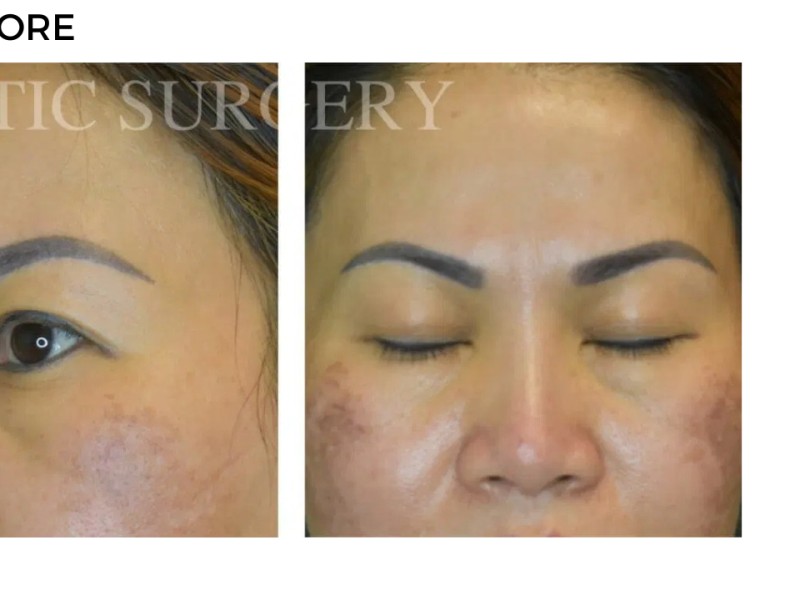 Procedure before and after - after
