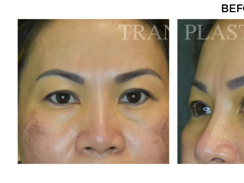 Procedure before and after - before