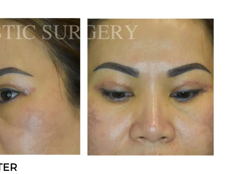Procedure before and after - after