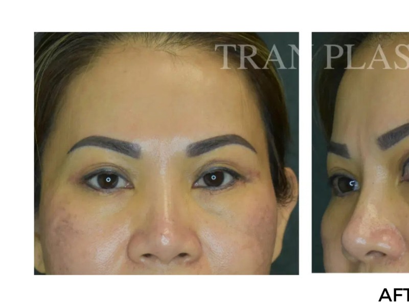 Procedure before and after - before