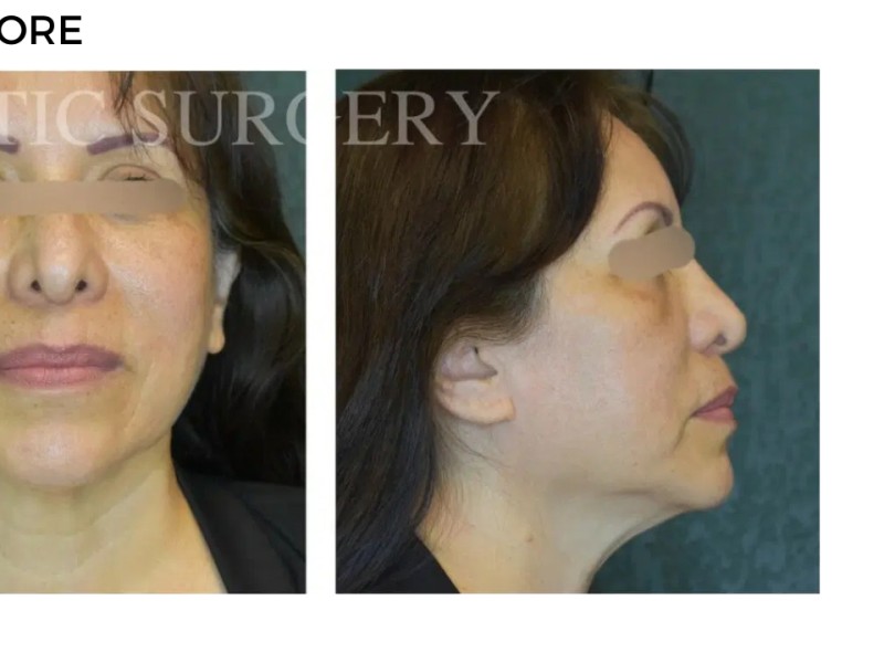 Procedure before and after - after