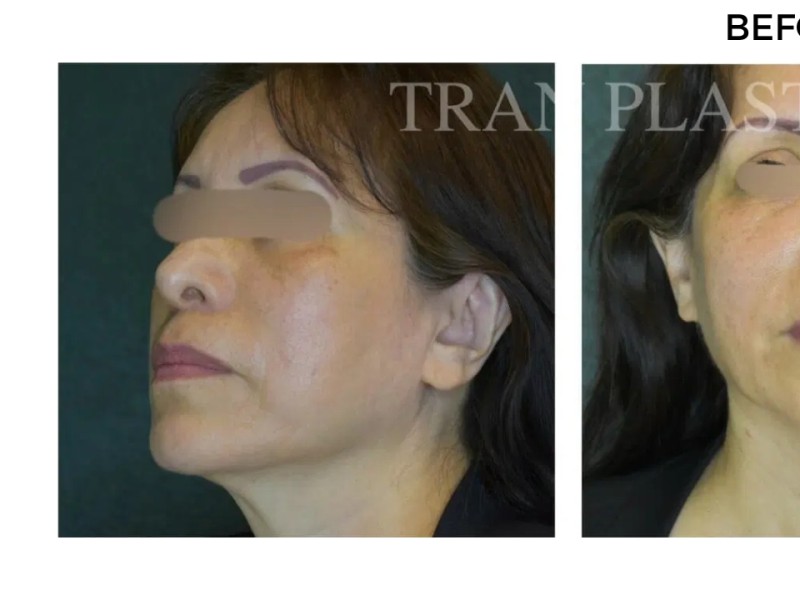 Procedure before and after - before