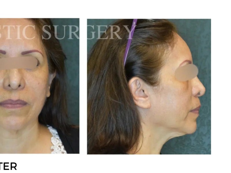 Procedure before and after - after