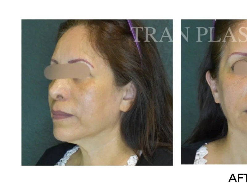 Procedure before and after - before