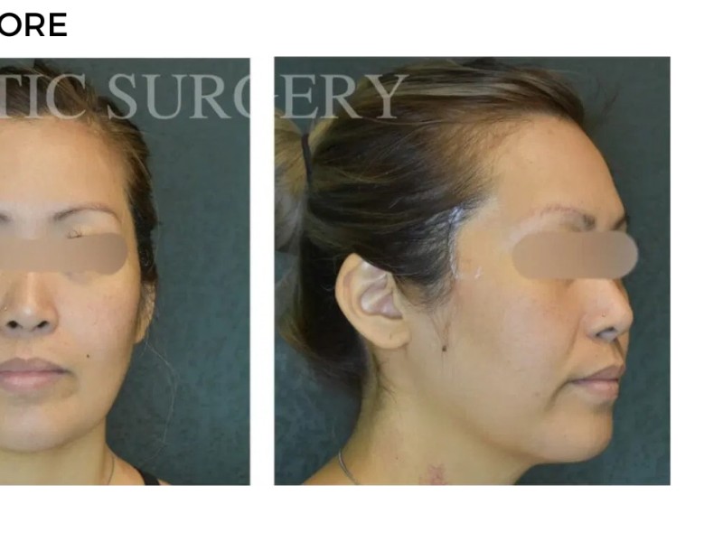 Procedure before and after - after