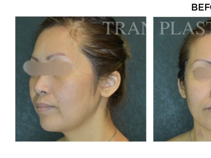 Procedure before and after - before
