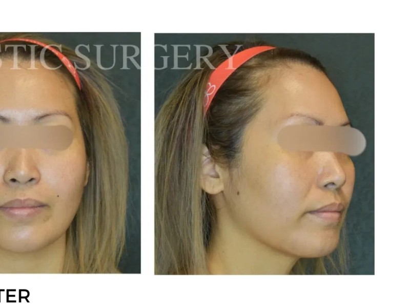 Procedure before and after - after