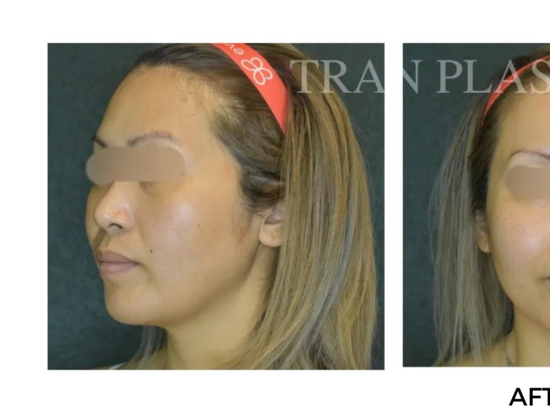 Procedure before and after - before