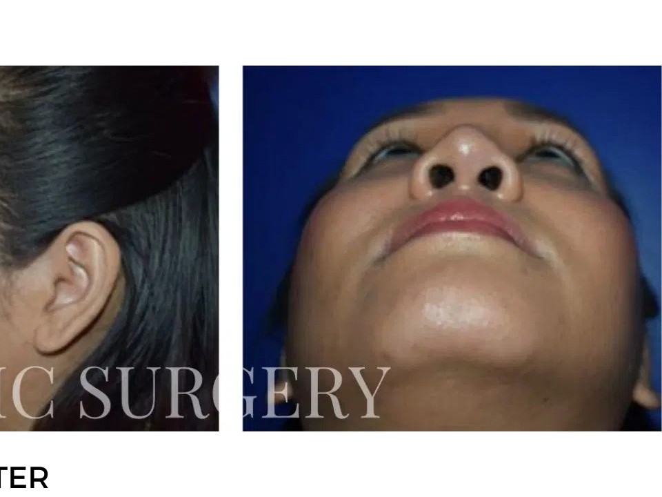 Procedure before and after - after