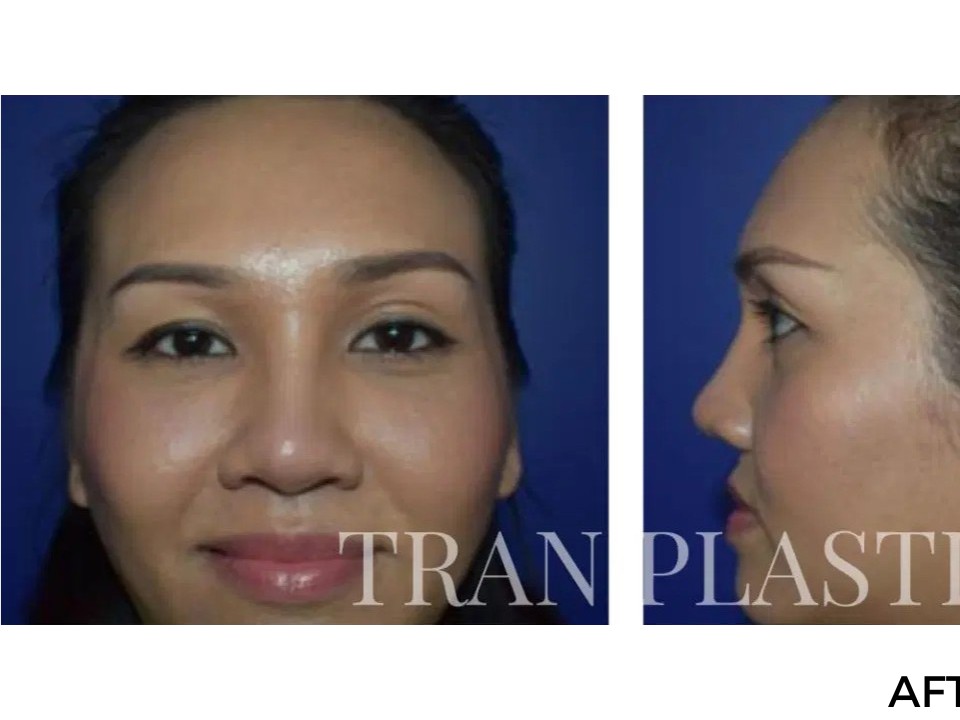 Procedure before and after - before
