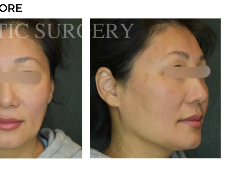 Procedure before and after - after