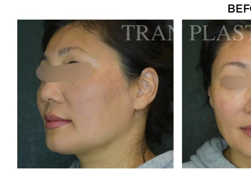 Procedure before and after - before