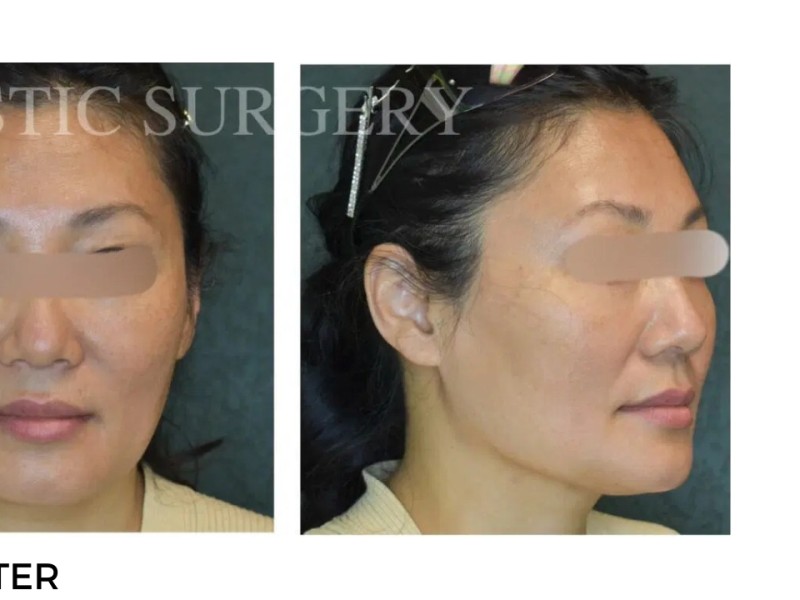 Procedure before and after - after