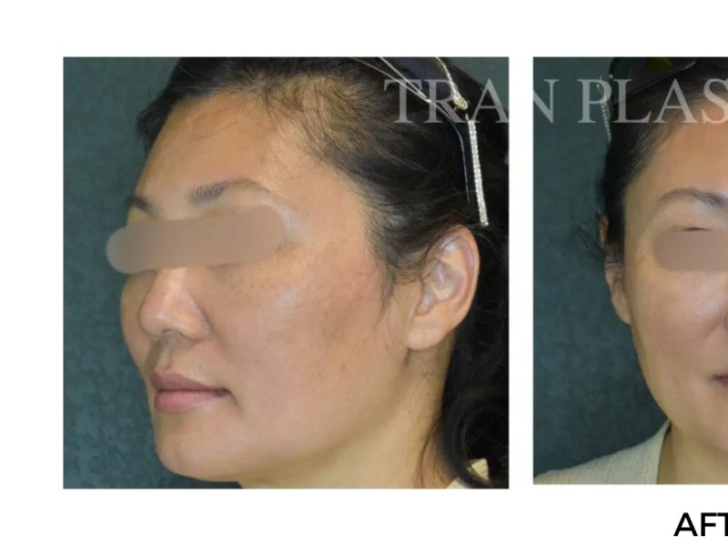 Procedure before and after - before