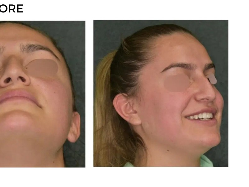 Procedure before and after - after
