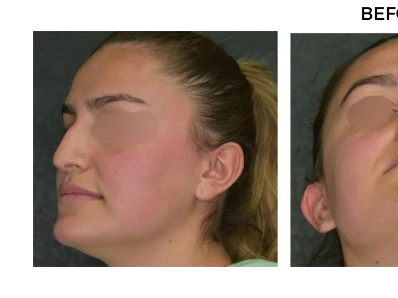 Procedure before and after - before
