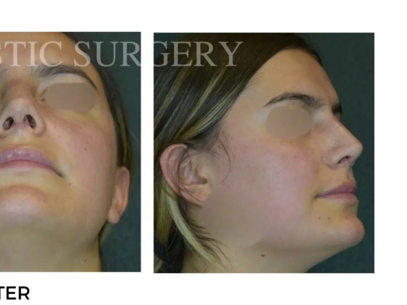 Procedure before and after - after