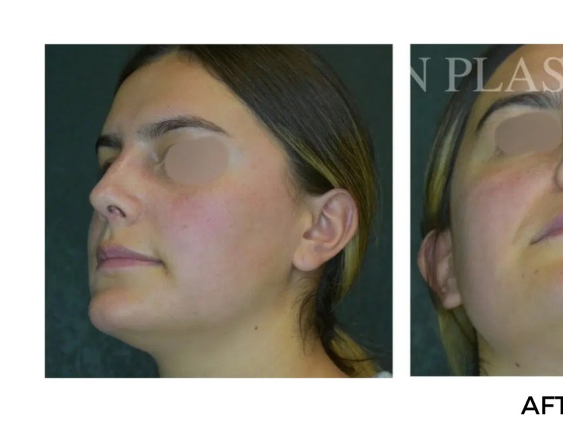 Procedure before and after - before