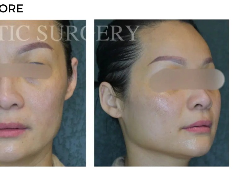 Procedure before and after - after