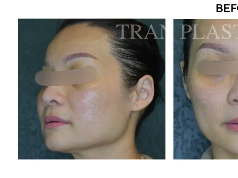 Procedure before and after - before