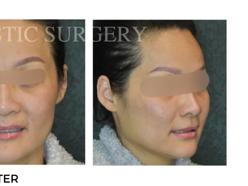Procedure before and after - after