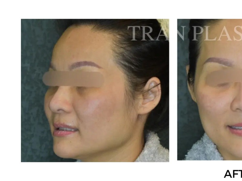Procedure before and after - before