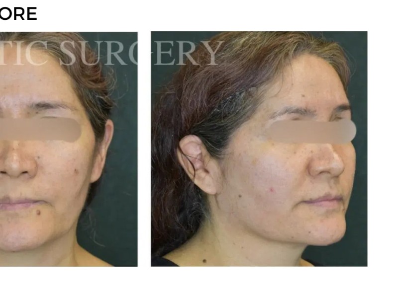 Procedure before and after - after