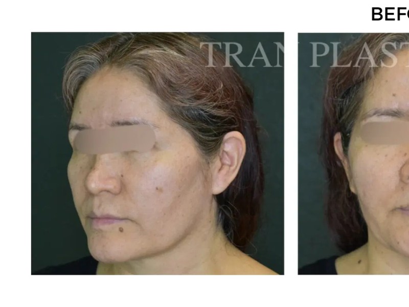 Procedure before and after - before