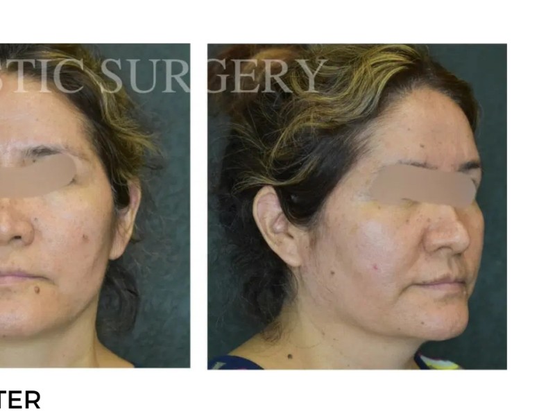 Procedure before and after - after