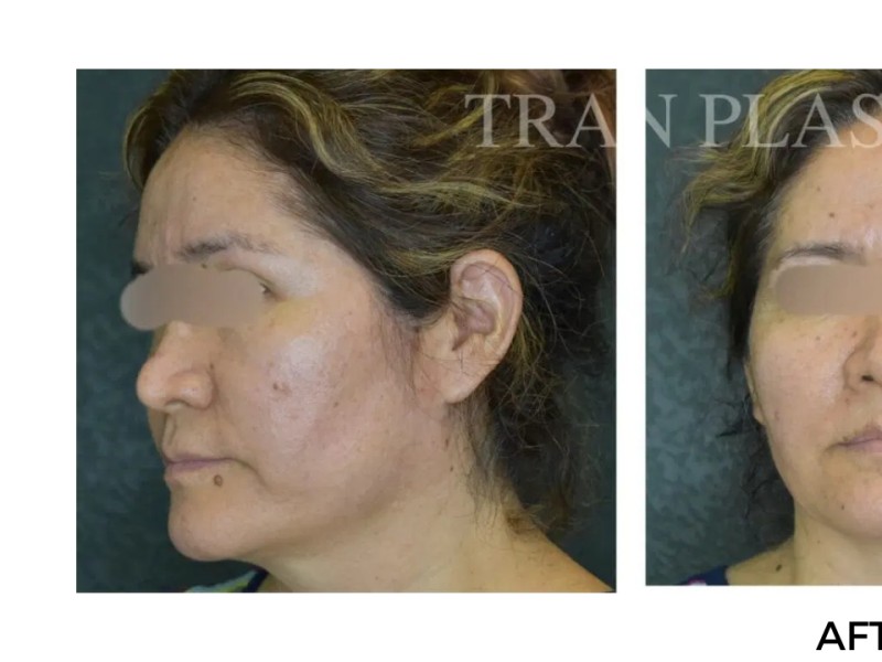 Procedure before and after - before