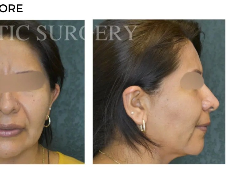 Procedure before and after - after
