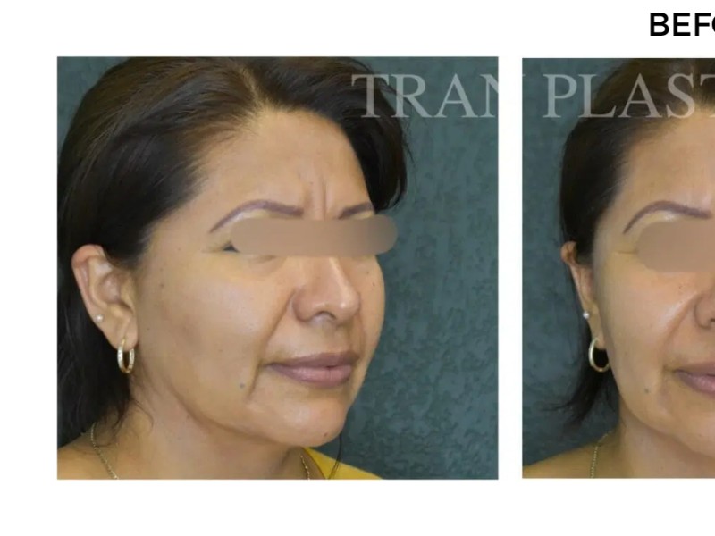 Procedure before and after - before