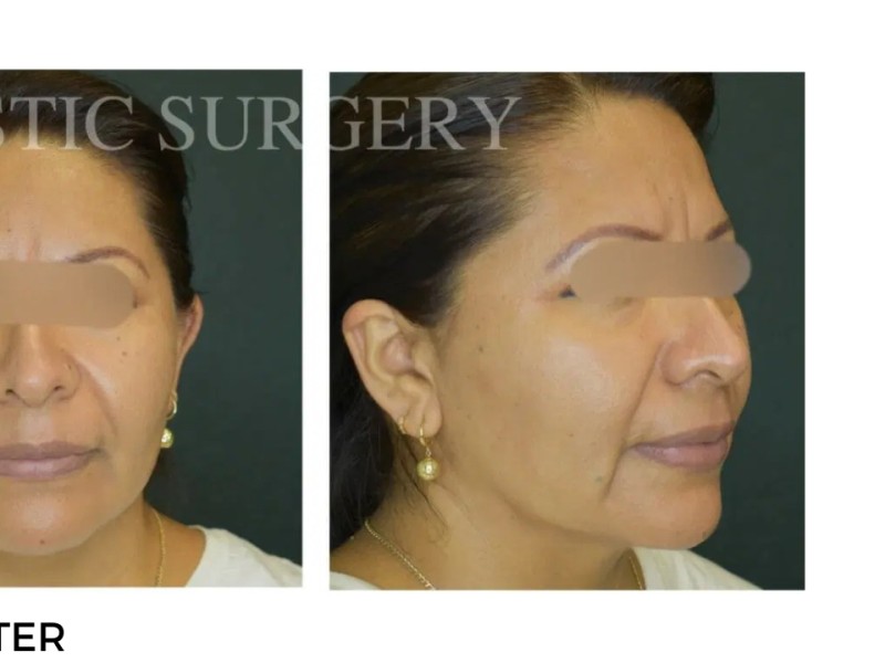 Procedure before and after - after