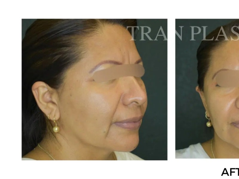 Procedure before and after - before